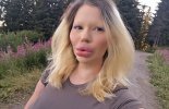 lips - too big plastic surgery.jpg